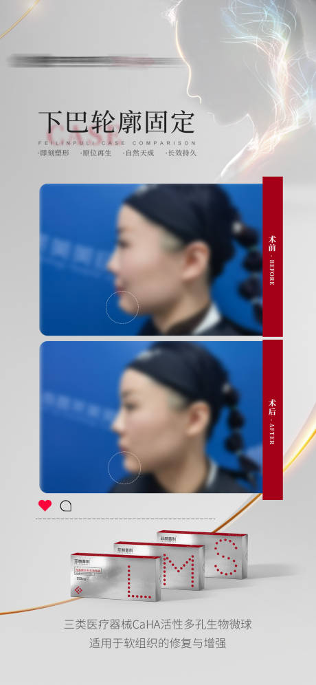 源文件下载【菲林普利下巴轮廓固定案例海报】编号：25410019333949896