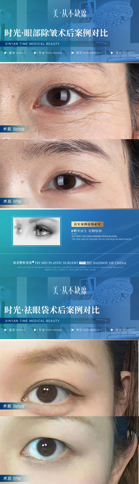 编号：20230921091501434【享设计】源文件下载-医美眼部除皱祛眼袋案例对比海报