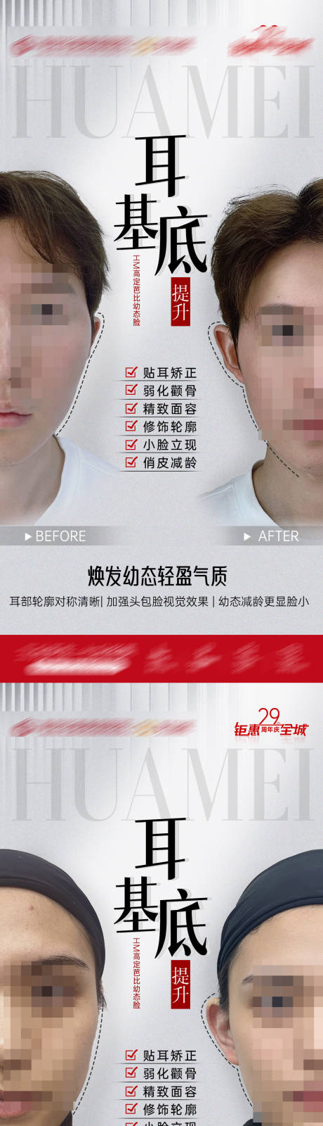 源文件下载【耳基底提升案例海报】编号：62000019350787238