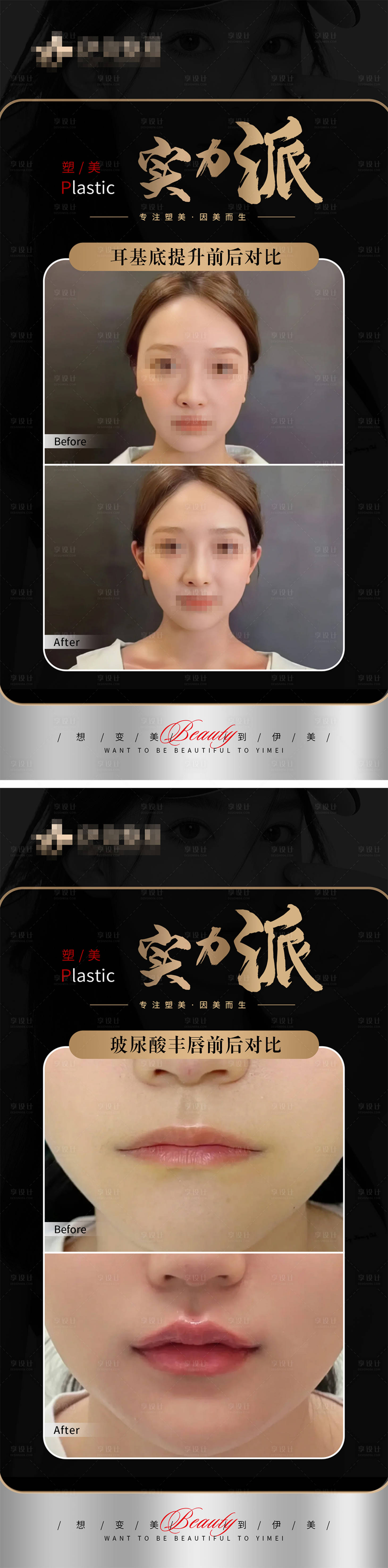 源文件下载【耳基底提升丰唇案例海报】编号：92740019195199999