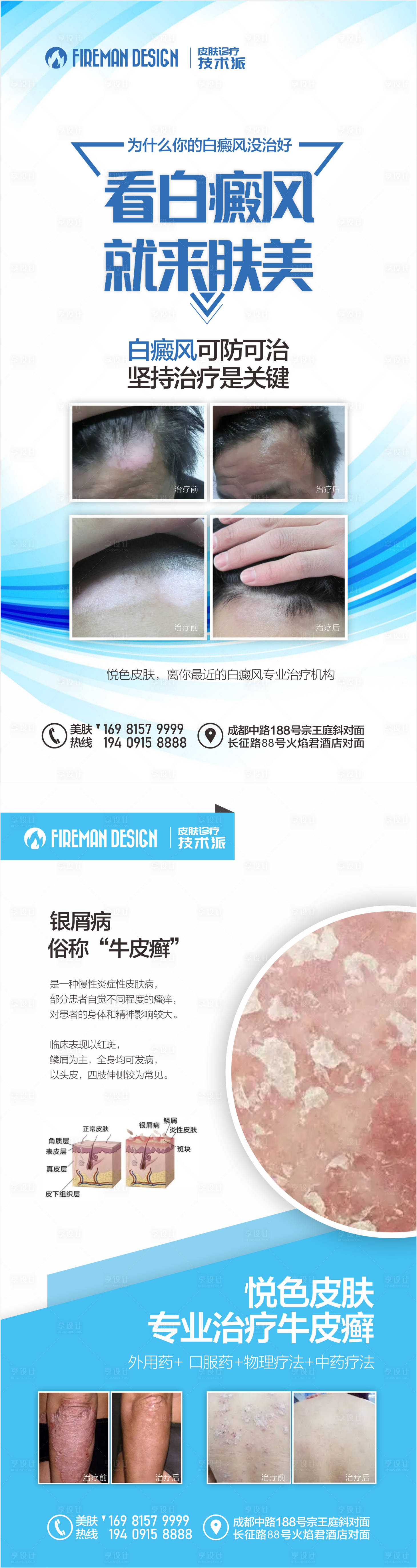 源文件下載【享設計】搜索編號：78450019190885546【白癜風銀屑病宣傳海報】