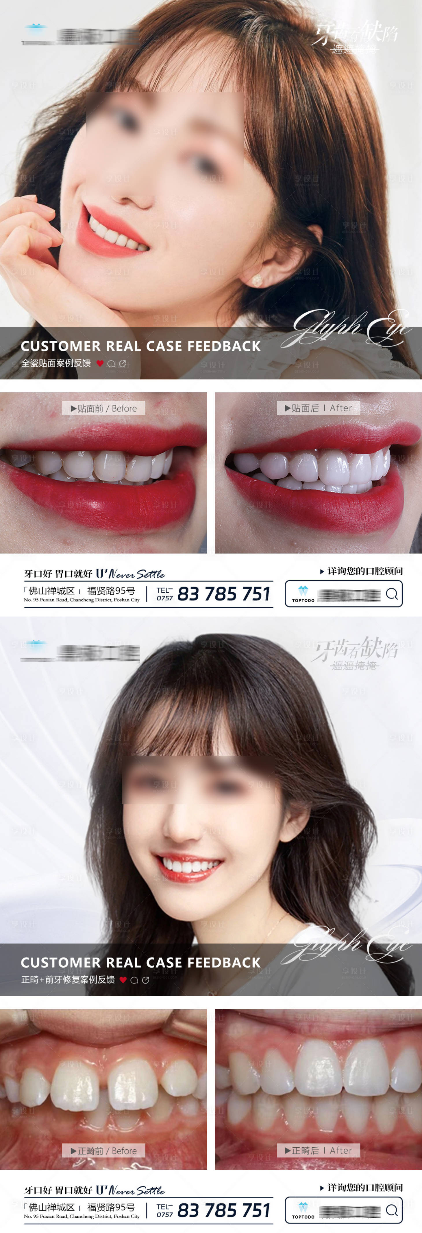 源文件下载【口腔贴面矫正案例海报】编号：57270019806513083