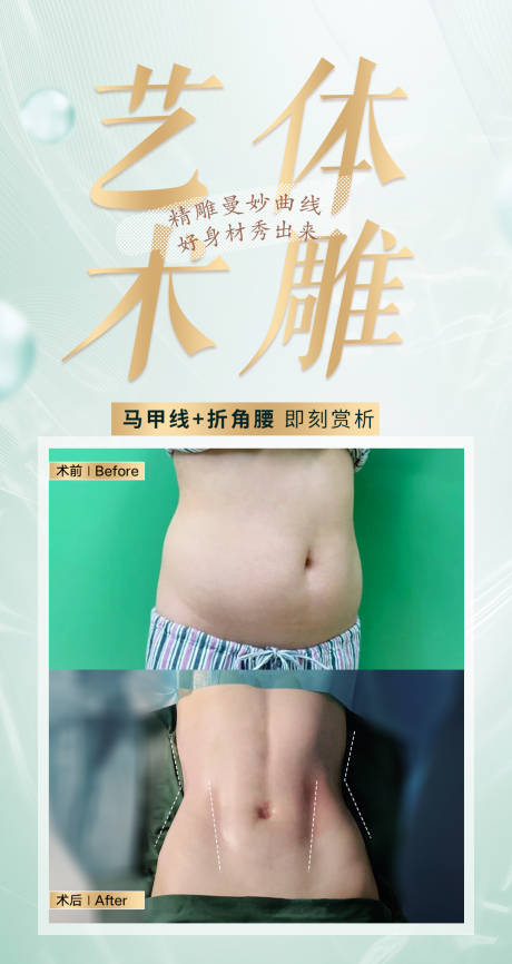 源文件下载【折角腰马甲线吸脂体雕案例】编号：20231003170423529