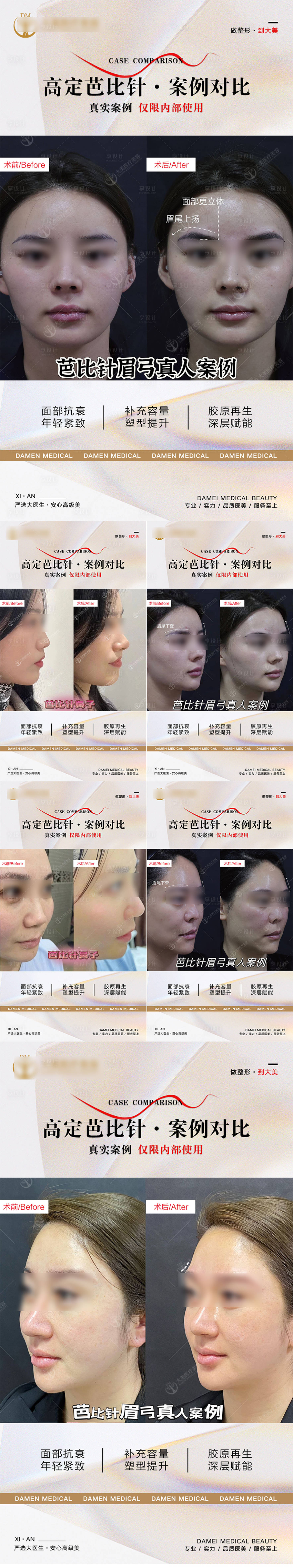 源文件下载【享设计】搜索编号：13340019812219698【医美整形芭比针面部抗衰案例系列海报】