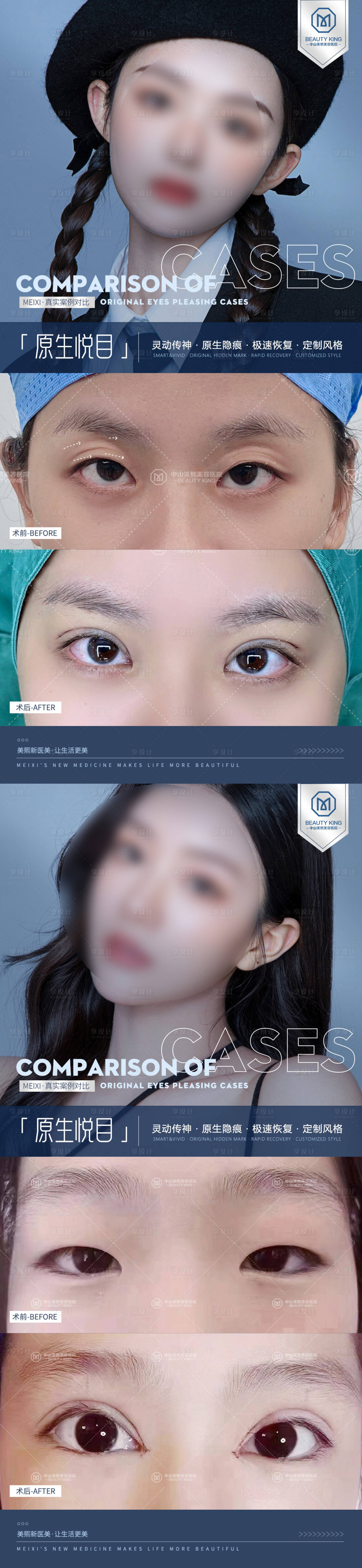源文件下载【享设计】搜索编号：49900019981931054【双眼皮案例海报】