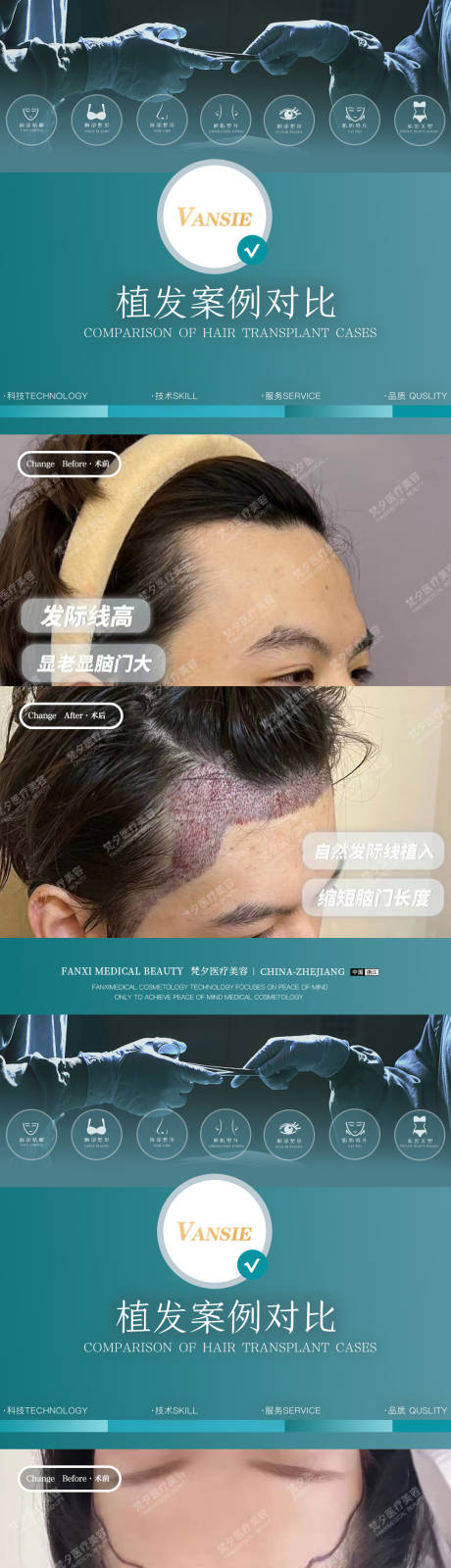 源文件下载【植发案例海报】编号：50350020092089342