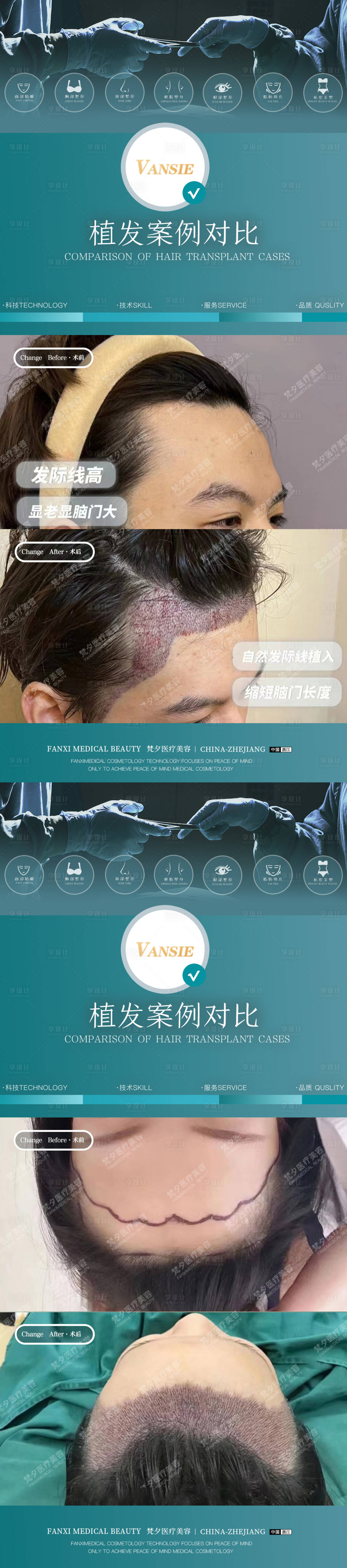 源文件下載【享設(shè)計(jì)】搜索編號(hào)：50350020092089342【植發(fā)案例海報(bào)】