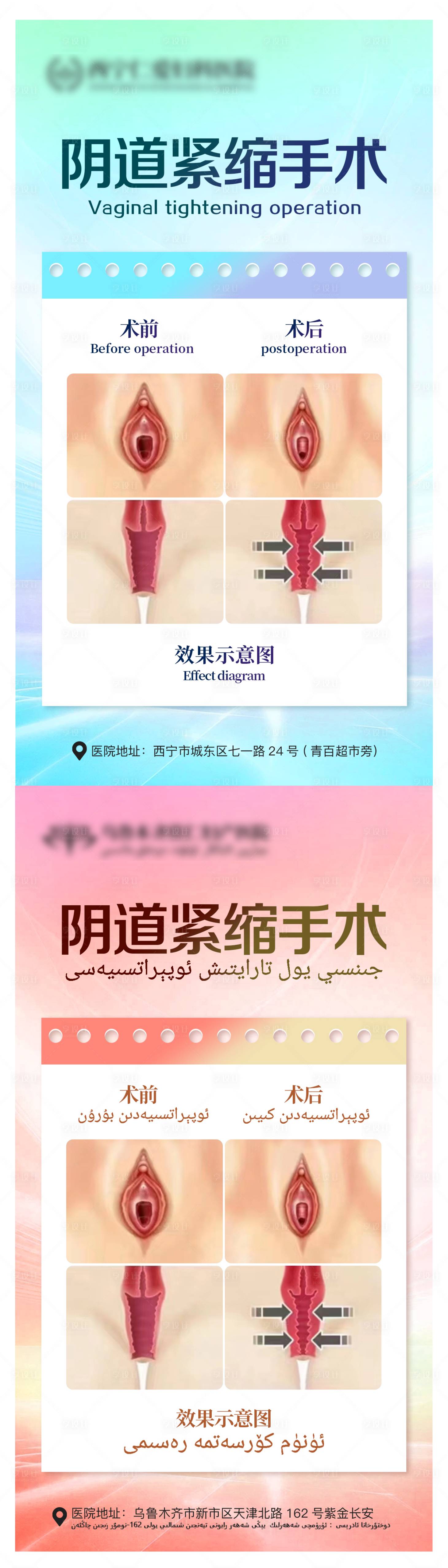 源文件下载【阴道紧缩手术海报】编号：61390019659799283