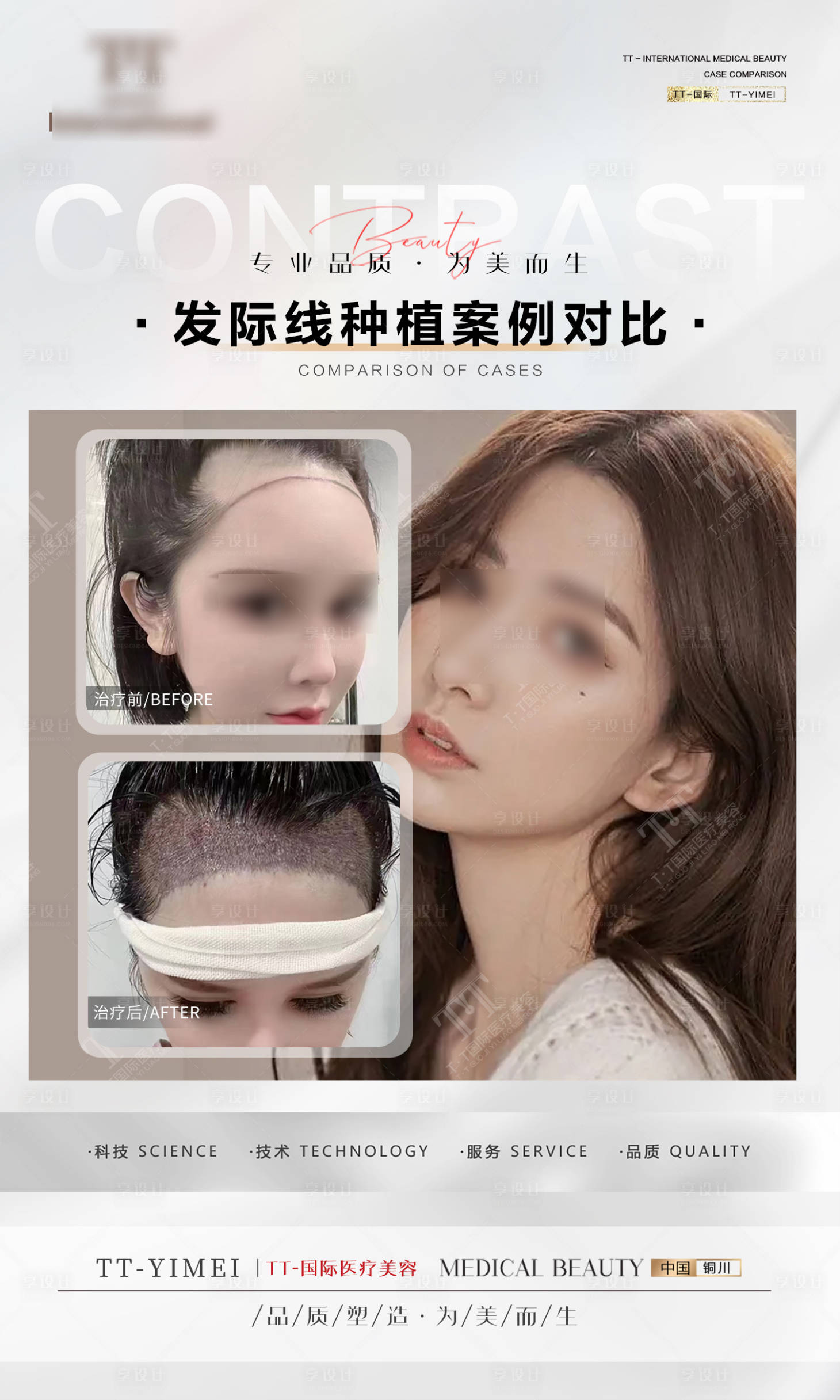 源文件下载【医美整形 案例对比 发际线植发】编号：34080019716842104