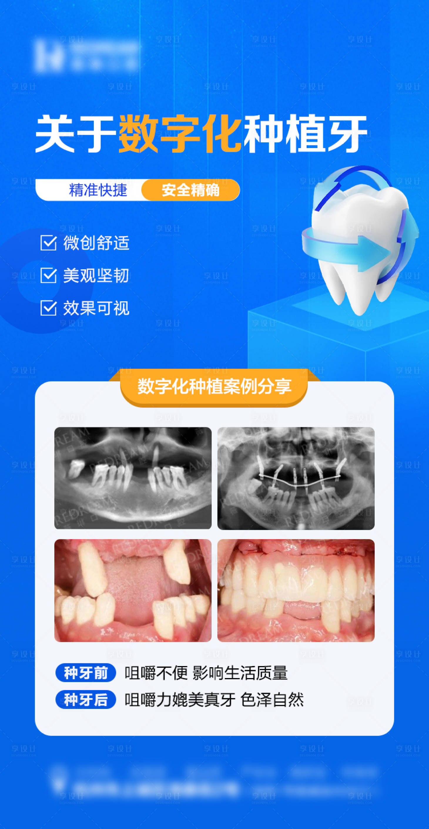 源文件下载【口腔种植牙海报】编号：90300019721406588