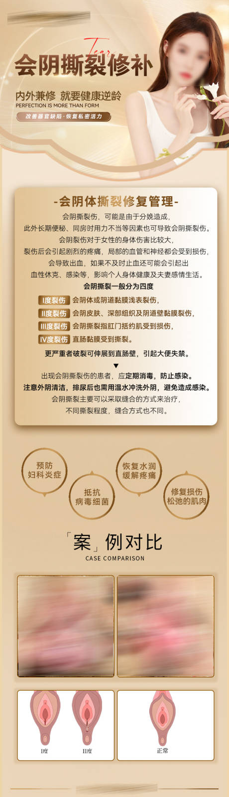 源文件下载【享设计】搜索编号：29990019744882821【会阴撕裂案例长图】