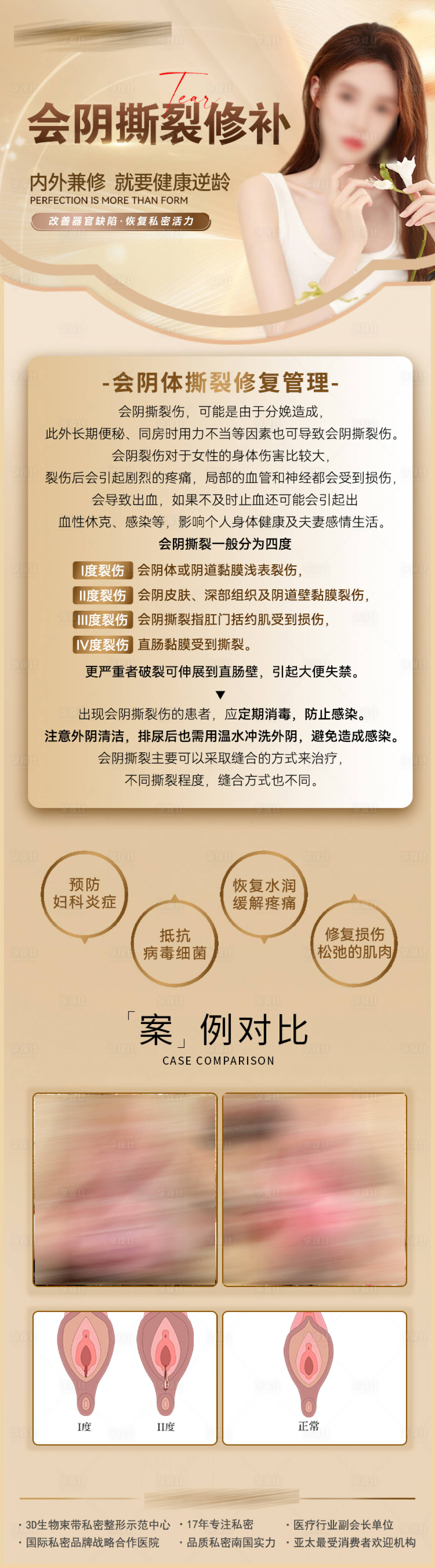 源文件下载【享设计】搜索编号：29990019744882821【会阴撕裂案例长图】