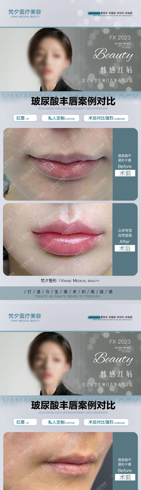 源文件下载【玻尿酸丰唇海报】编号：11360019913929731