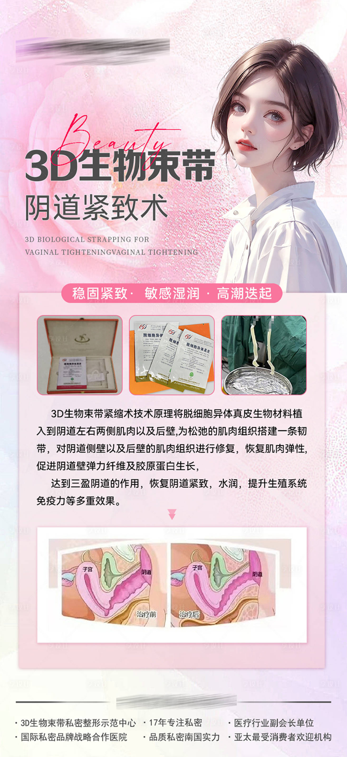 源文件下载【享设计】搜索编号：38220019746009107【3D生物束带阴道紧致术】