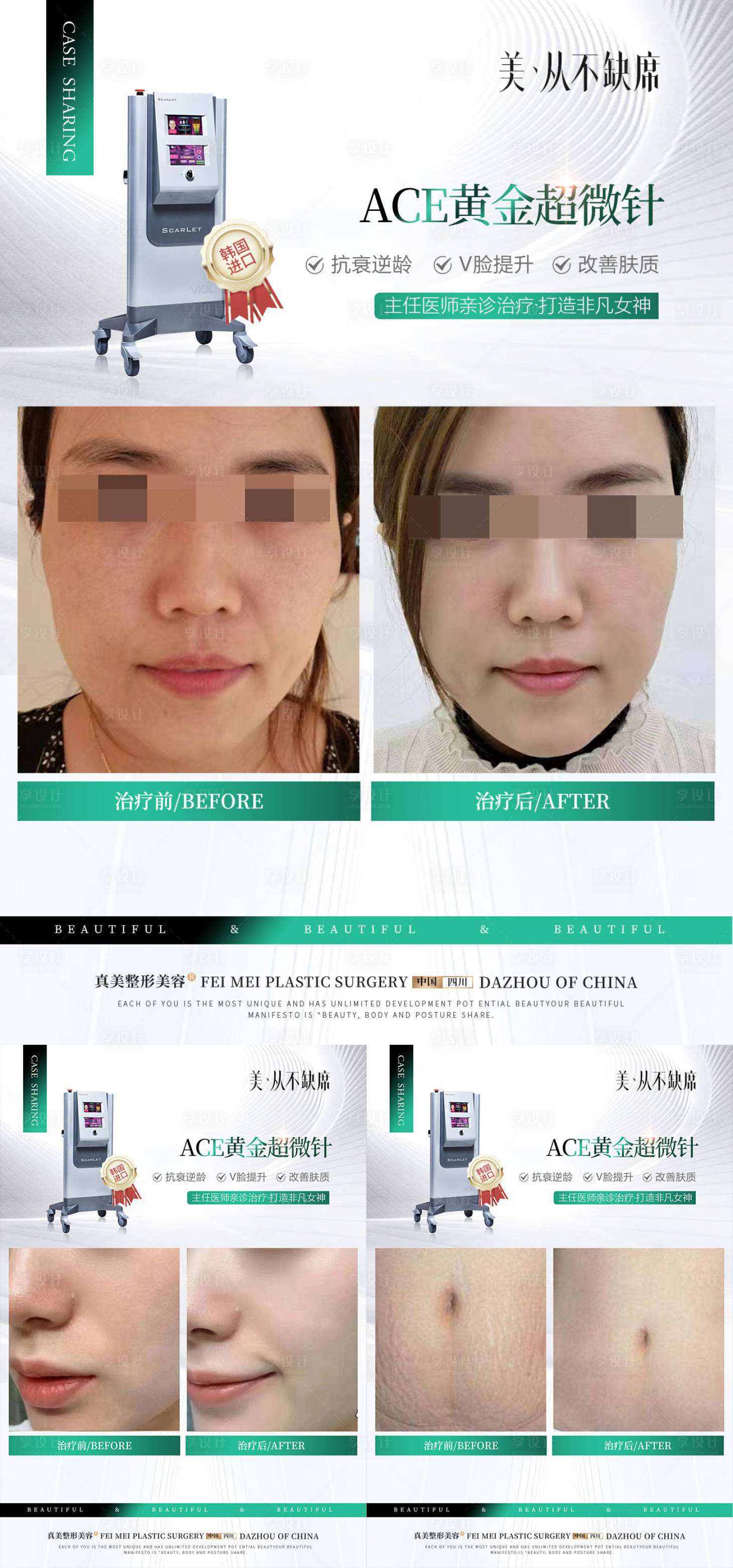 源文件下载【享设计】搜索编号：96150019806444534【医美黄金超微针案例妊娠纹嫩肤】