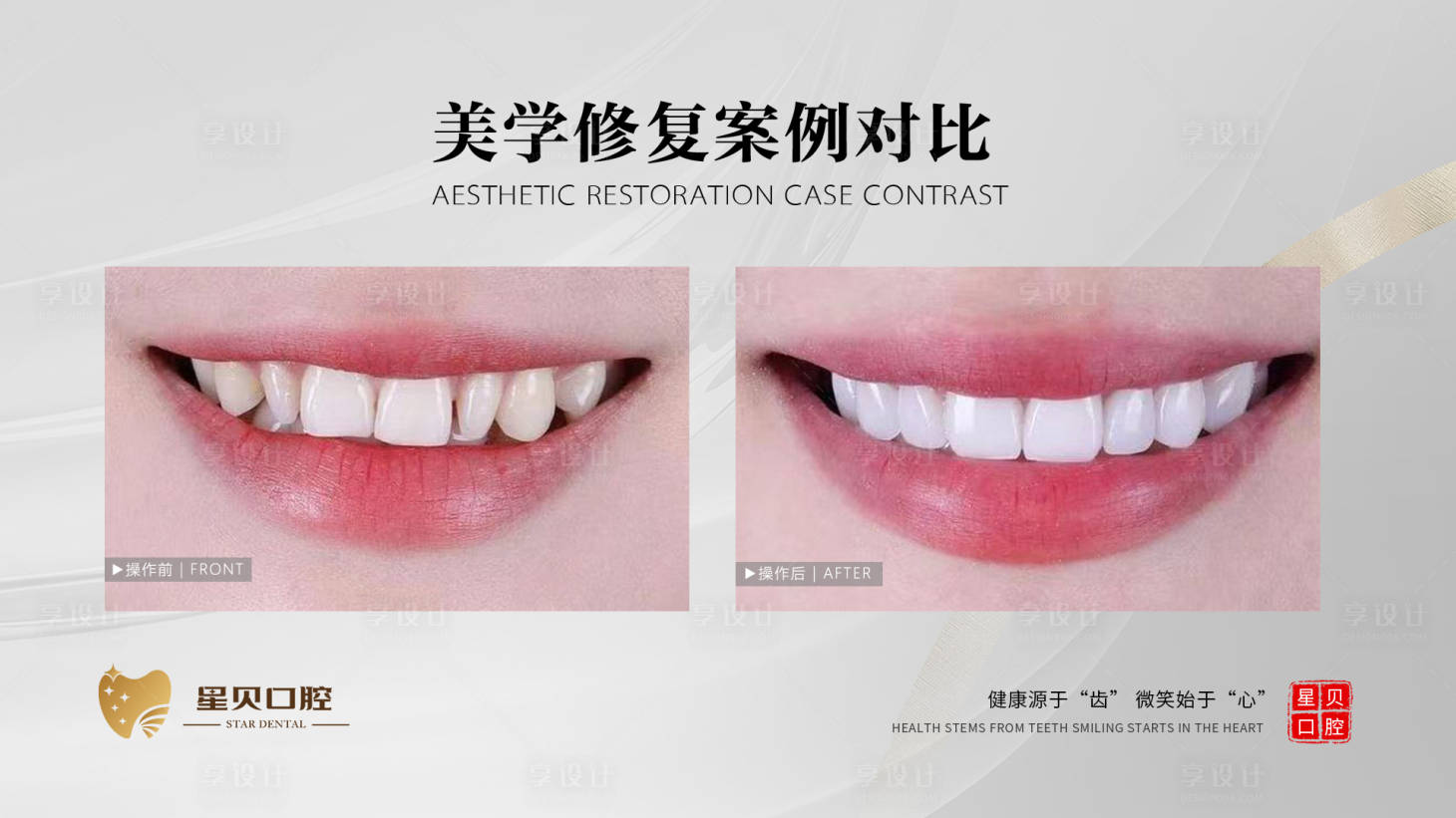 源文件下载【享设计】搜索编号：90490019837437304【口腔美学对比图】