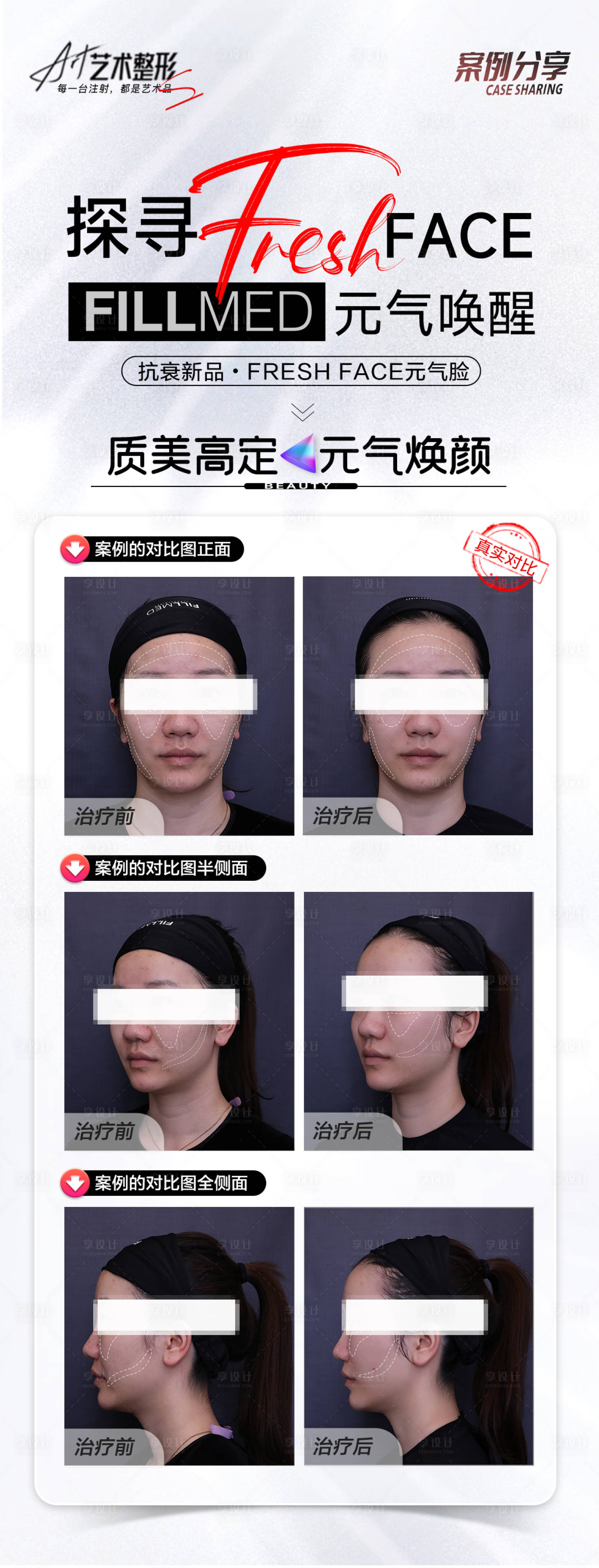 源文件下載【享設(shè)計】搜索編號：78380019603722077【醫(yī)美案例海報】