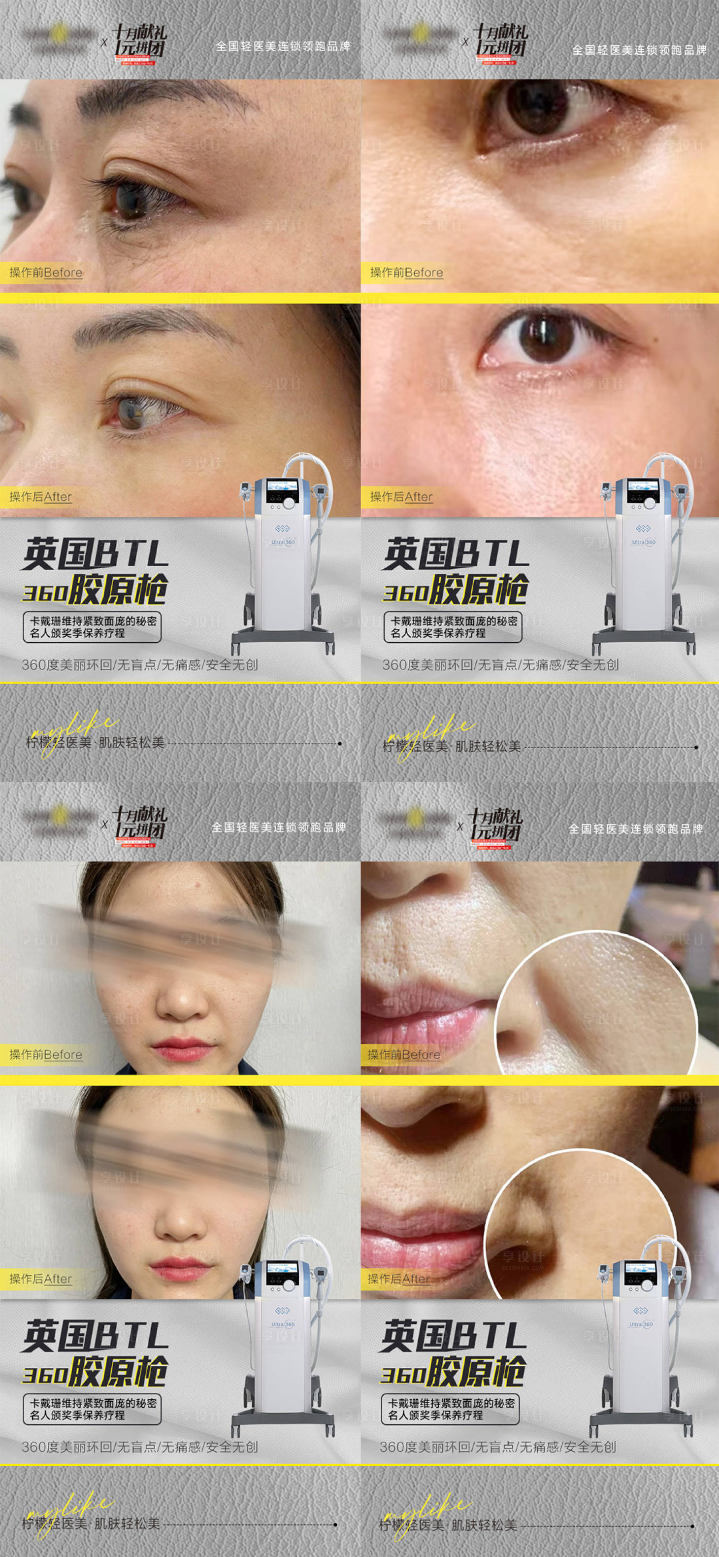 源文件下载【享设计】搜索编号：67490020690049684【医美仪器抗衰案例对比】