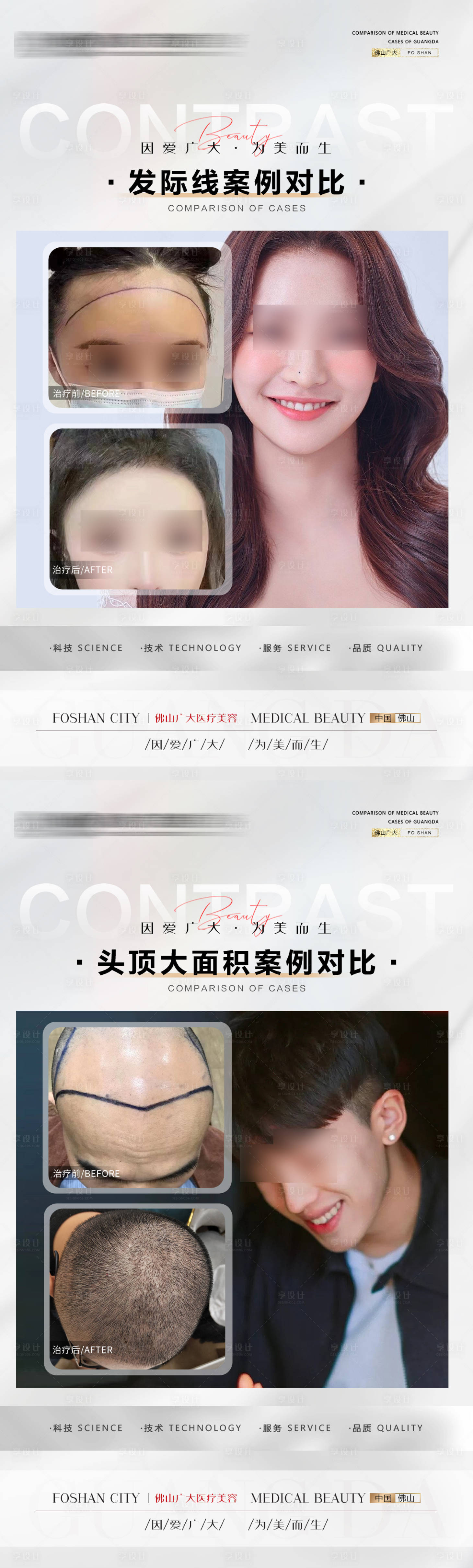 源文件下载【植发案例】编号：54730020495727379