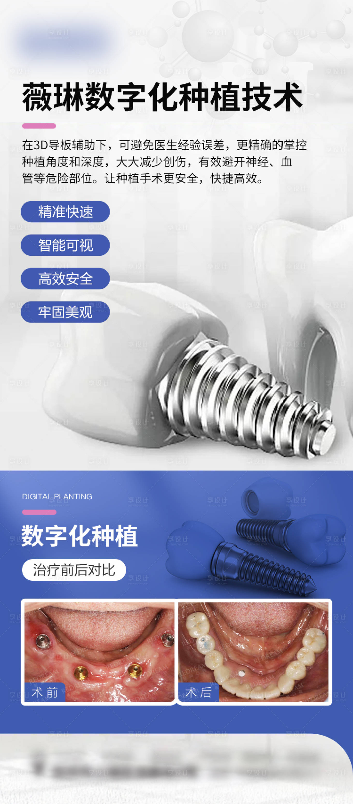 源文件下載【享設計】搜索編號：52290020619819651【口腔種植牙簡約海報】