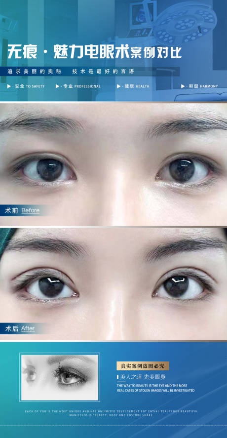 源文件下载【医美案例双眼皮海报】编号：80020020246282397
