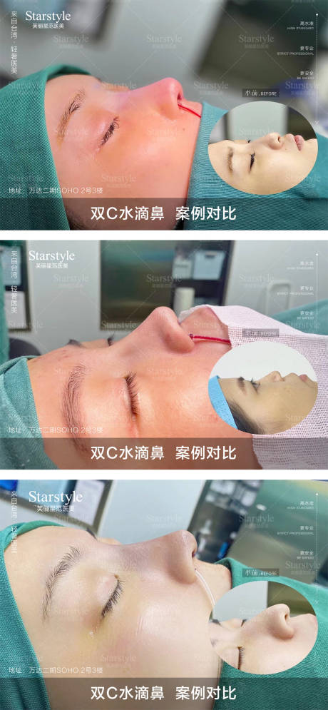 源文件下載【醫美鼻子案例對比海報展板】編號：41960020689853358