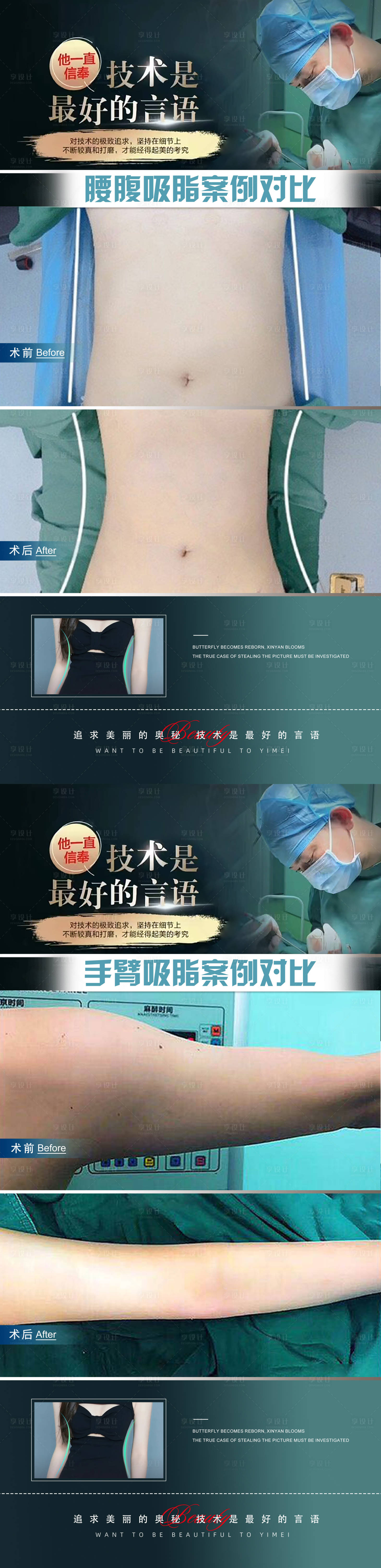 源文件下載【醫(yī)美手部腰部抽脂吸脂案例對比海報】編號：82180020312821087