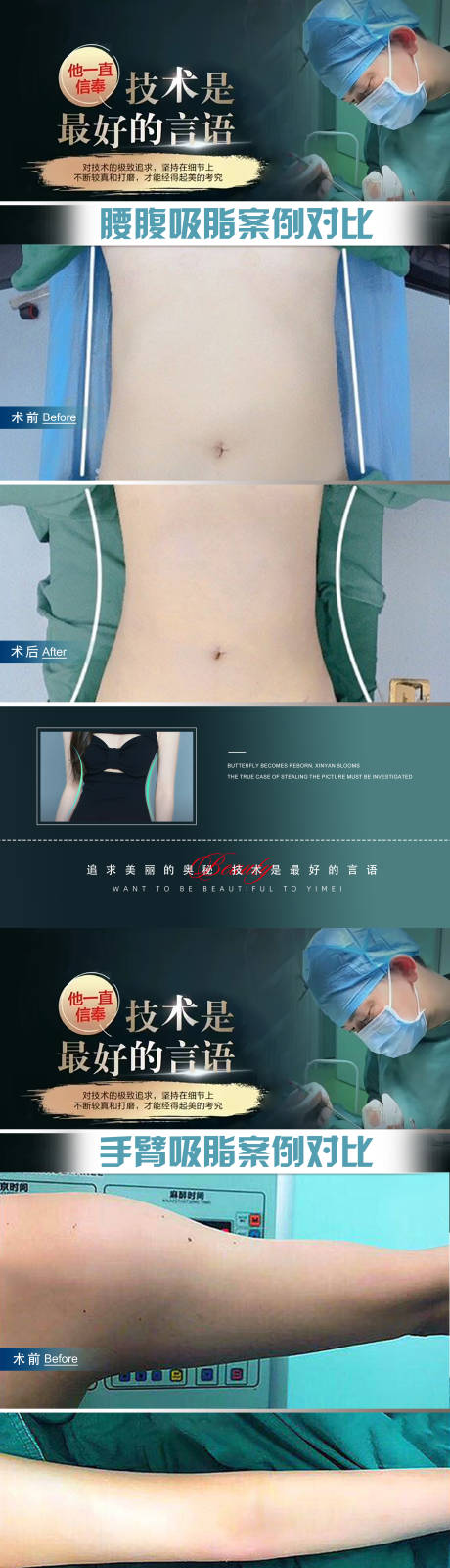编号：20231110094234194【享设计】源文件下载-医美手部腰部抽脂吸脂案例对比海报