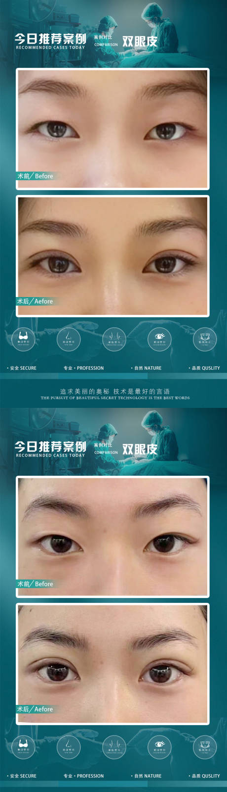 源文件下載【醫美案例雙眼皮海報】編號：97530020553528102