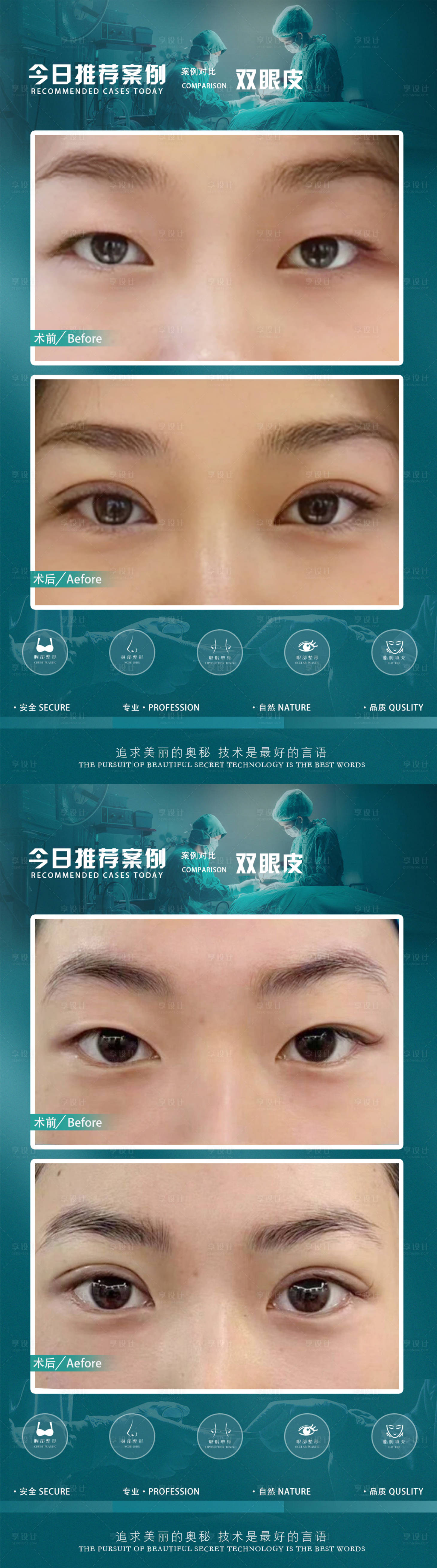 源文件下载【医美案例双眼皮海报】编号：97530020553528102