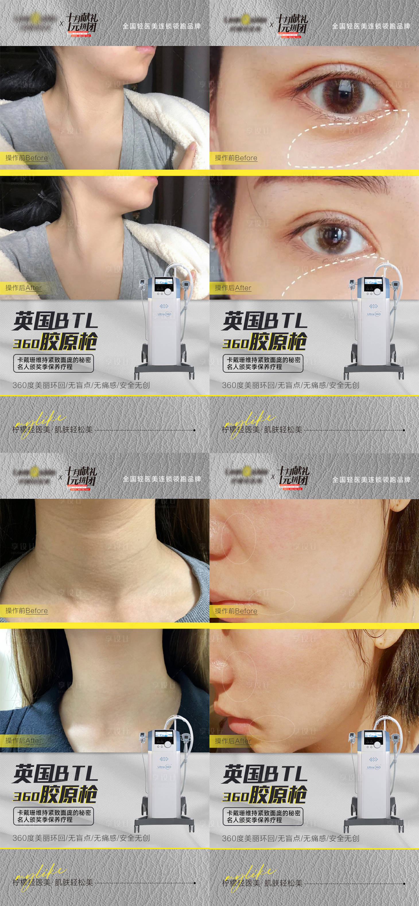 源文件下載【享設(shè)計(jì)】搜索編號：17330020689975329【醫(yī)美儀器抗衰案例對比系列海報(bào)】