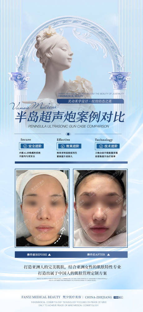源文件下載【半島超聲炮案例對比海報】編號：54960020216047113