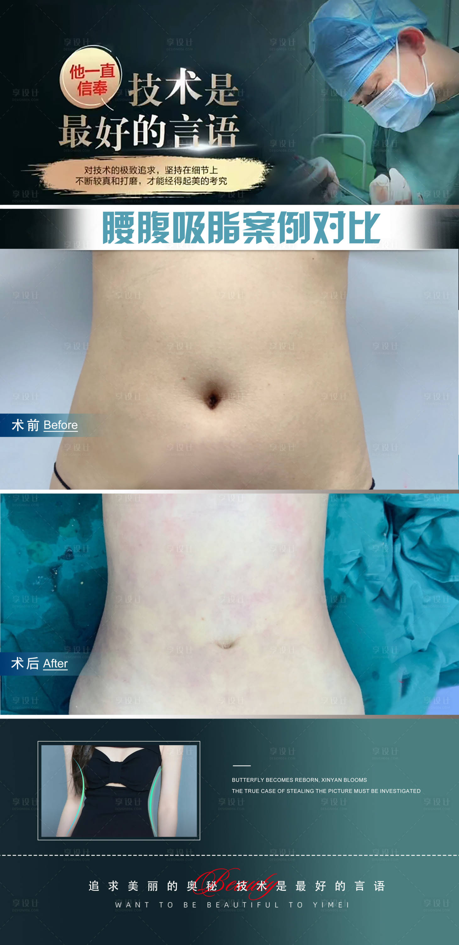 源文件下载【享设计】搜索编号：76380020273249987【腰腹抽脂案例对比海报】