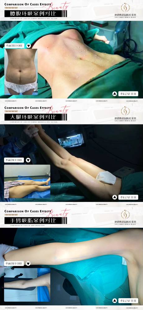 源文件下载【医美吸脂案例系列】编号：85710020696509993