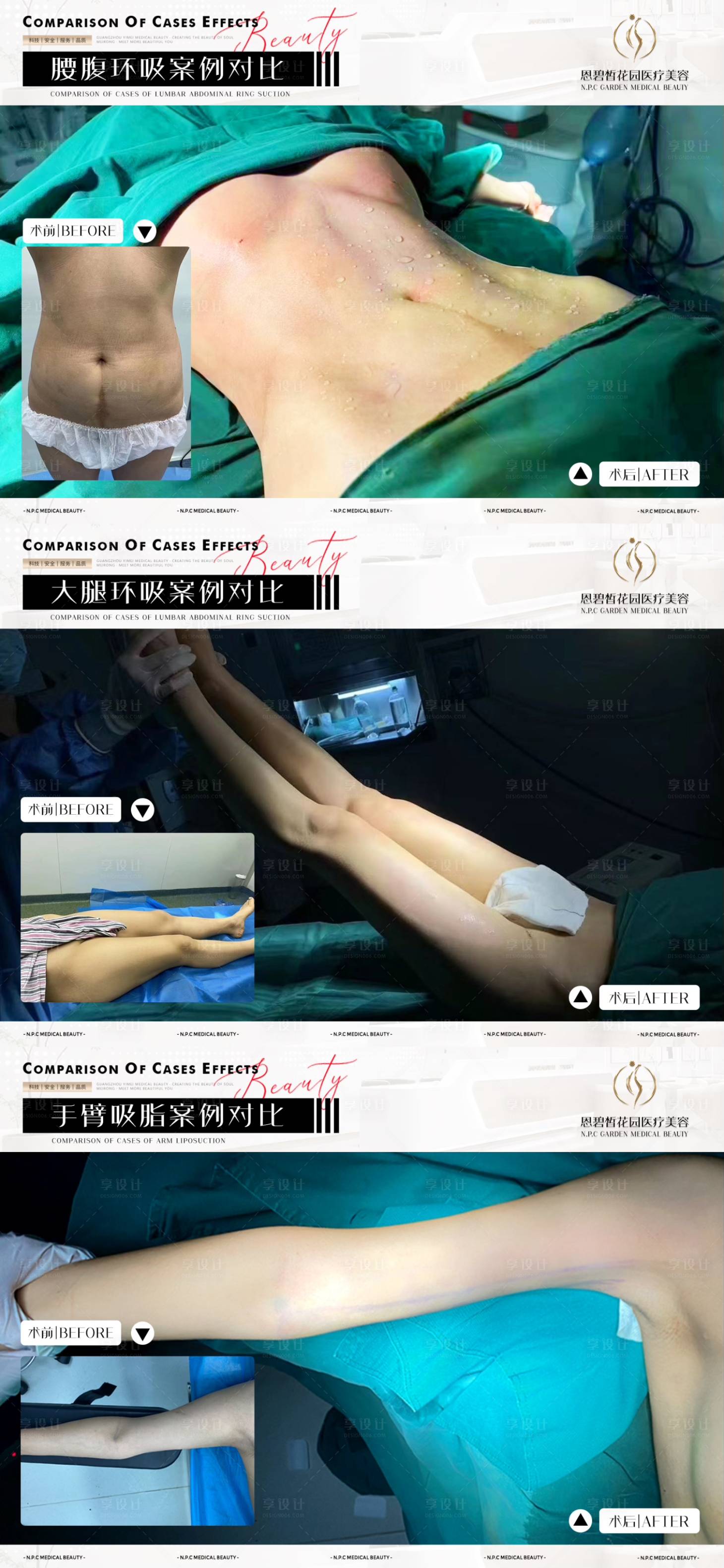 源文件下载【医美吸脂案例系列】编号：85710020696509993