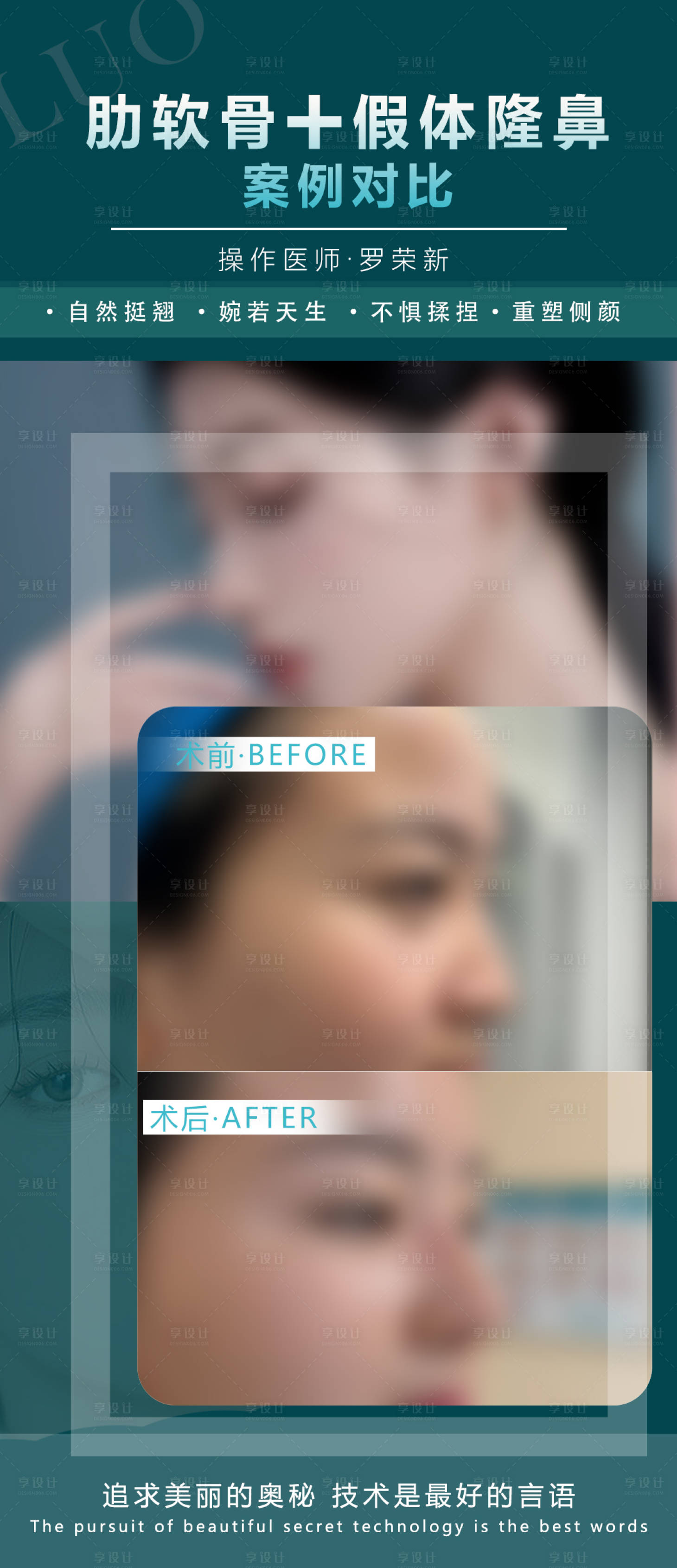 源文件下载【享设计】搜索编号：87280020673068374【医美案例隆鼻海报】