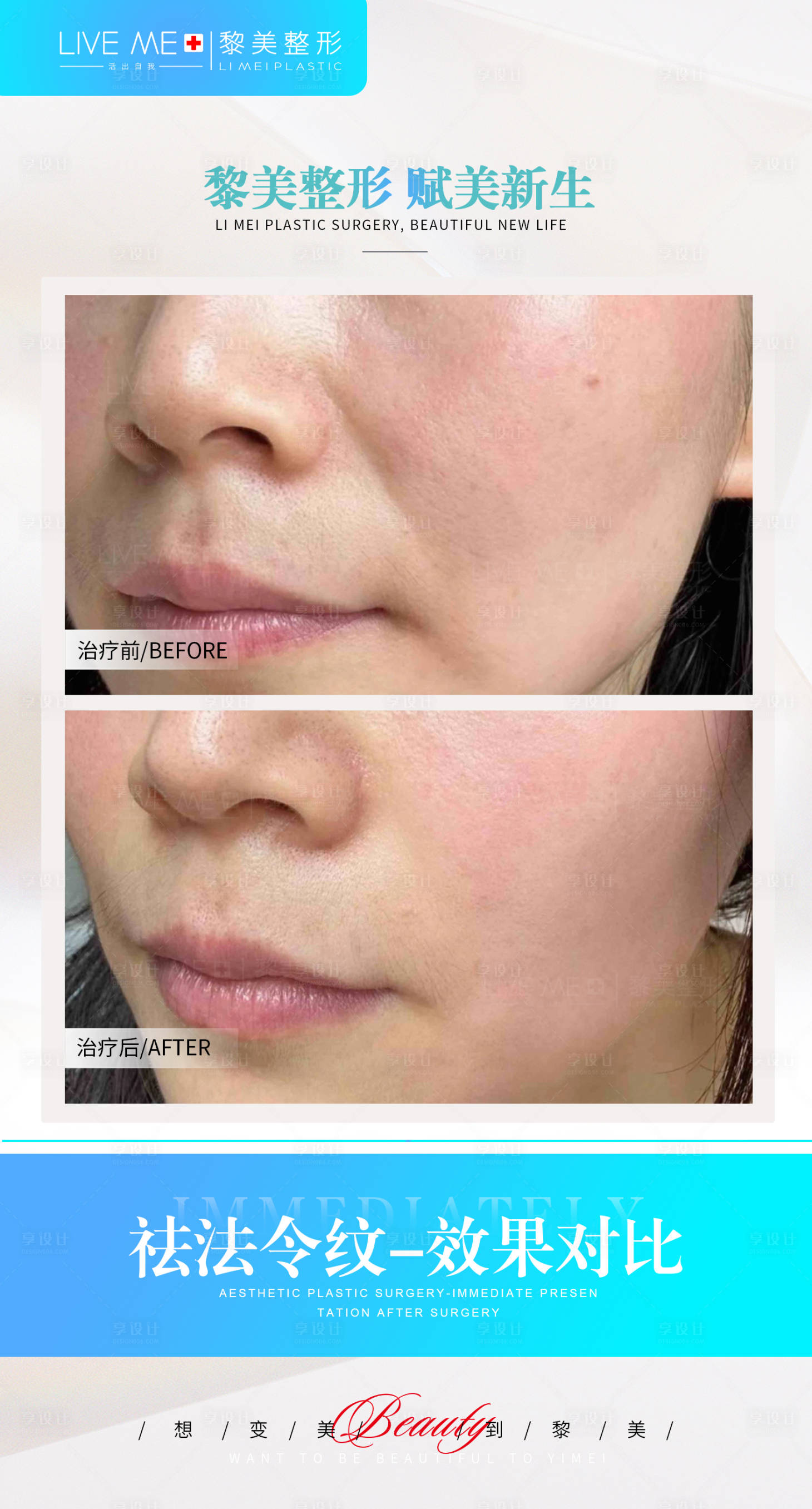 源文件下载【享设计】搜索编号：53030020383709425【祛法令纹案例海报】