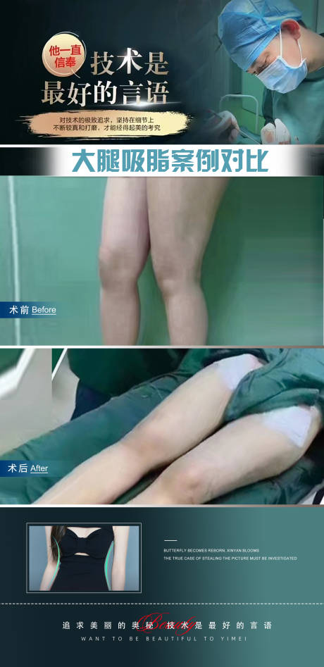 源文件下载【腿部吸脂抽脂案例对比 海报】编号：32470020312566625