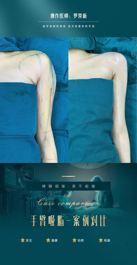 编号：20231128104802036【享设计】源文件下载-医美案例手臂吸脂海报