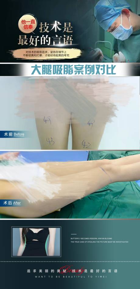 编号：20231110101105015【享设计】源文件下载-医美腿部抽脂案例海报