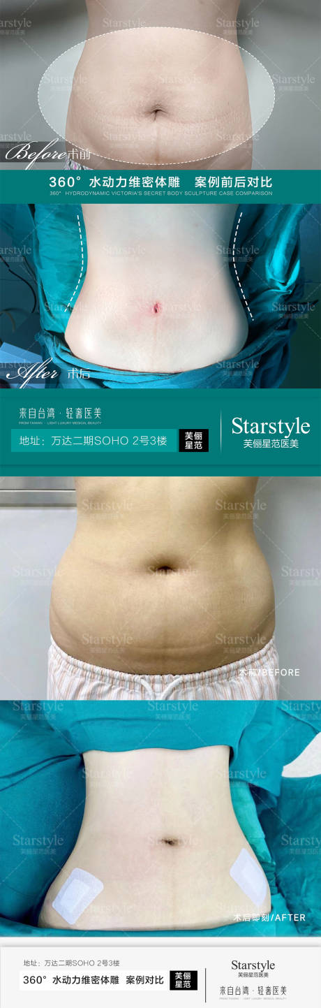 源文件下载【医美吸脂案例对比系列海报】编号：62110020690232437