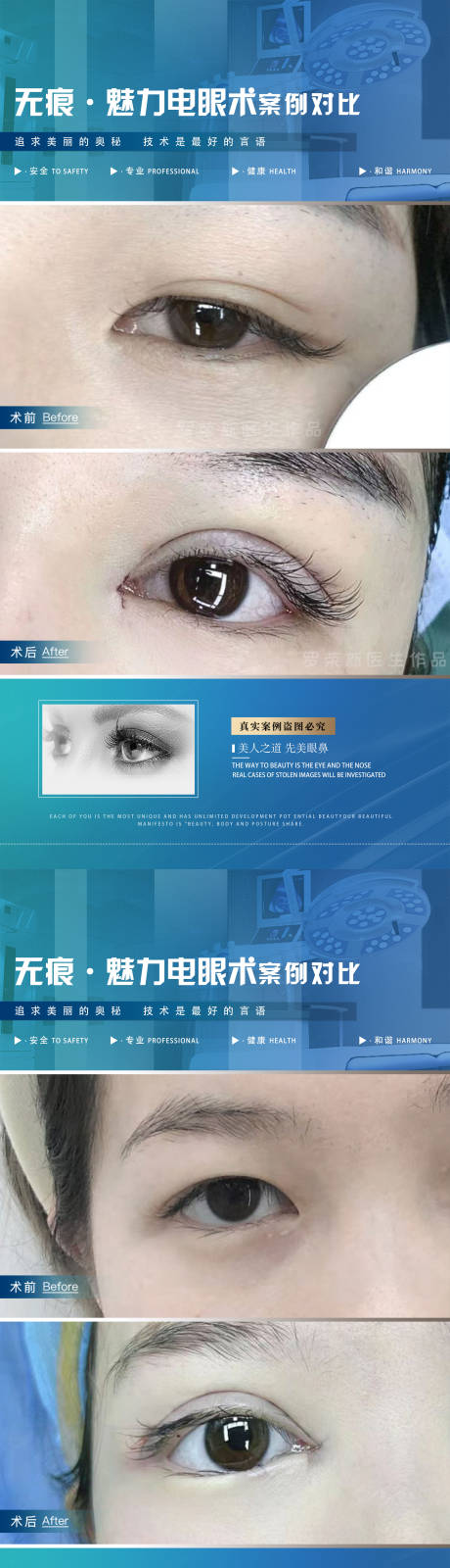 源文件下载【医美案例双眼皮海报】编号：45640020553927880