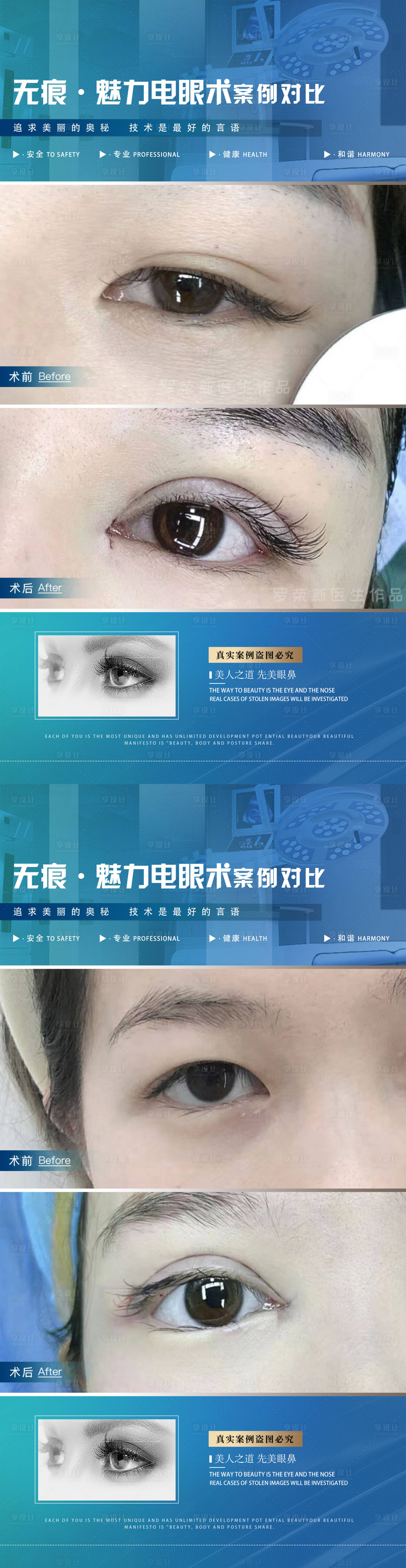 源文件下载【医美案例双眼皮海报】编号：45640020553927880