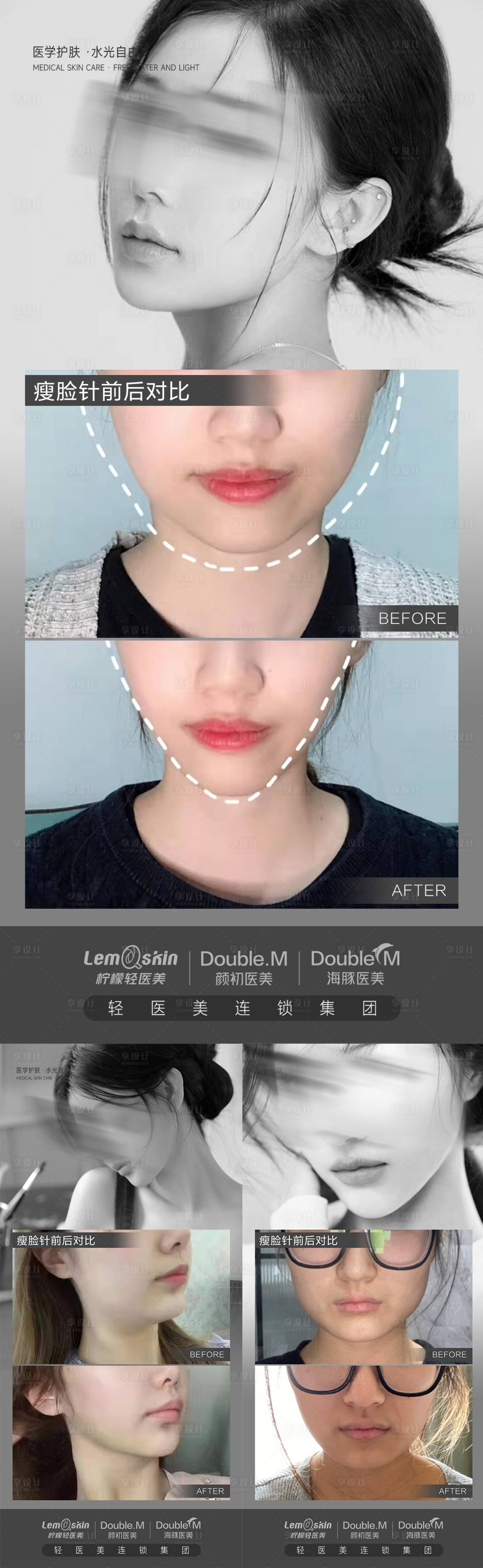 源文件下載【享設計】搜索編號：28780020689721612【醫美瘦臉案例對比系列海報】