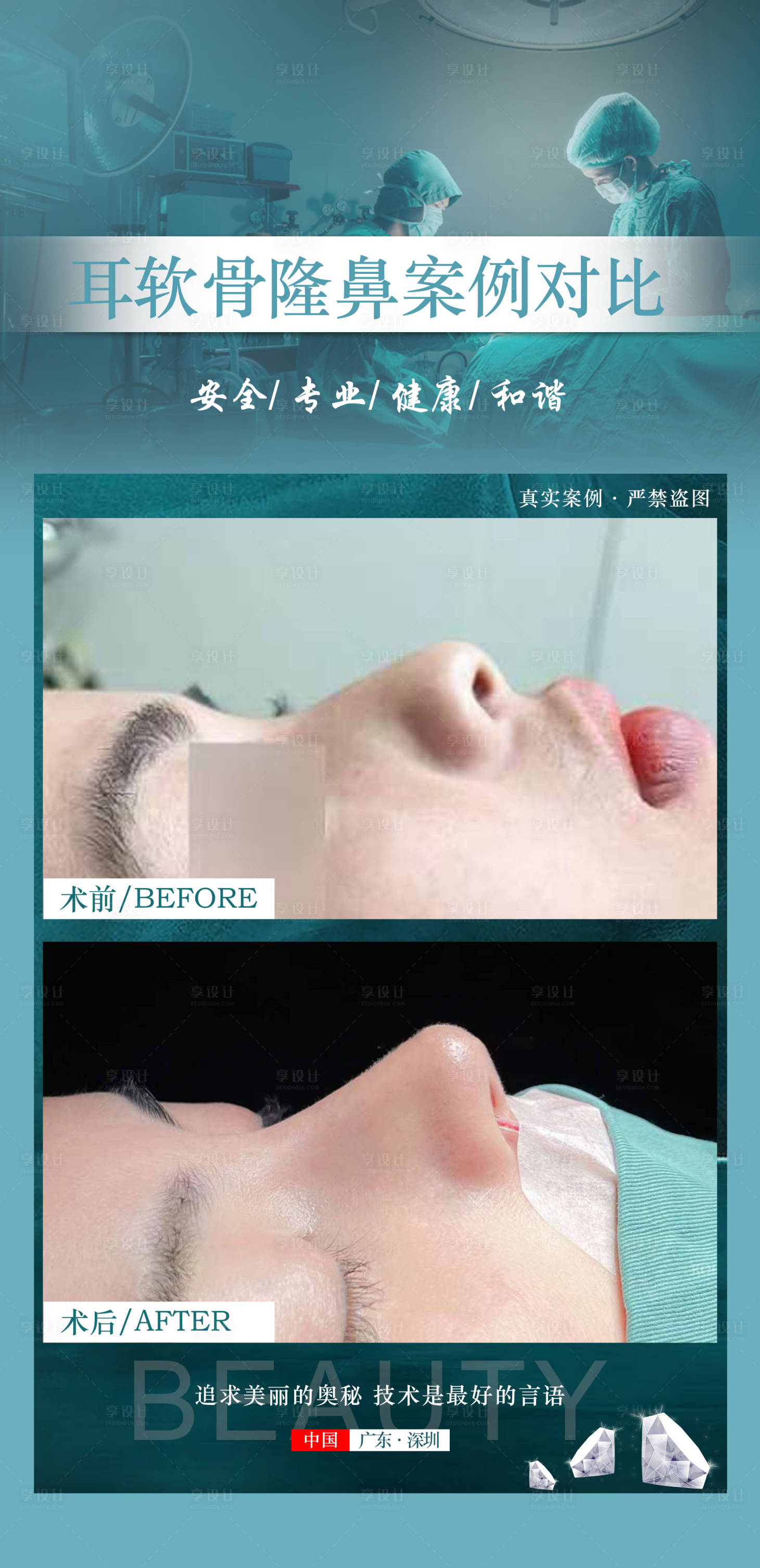 源文件下载【享设计】搜索编号：42820020249929143【医美案例隆鼻海报】