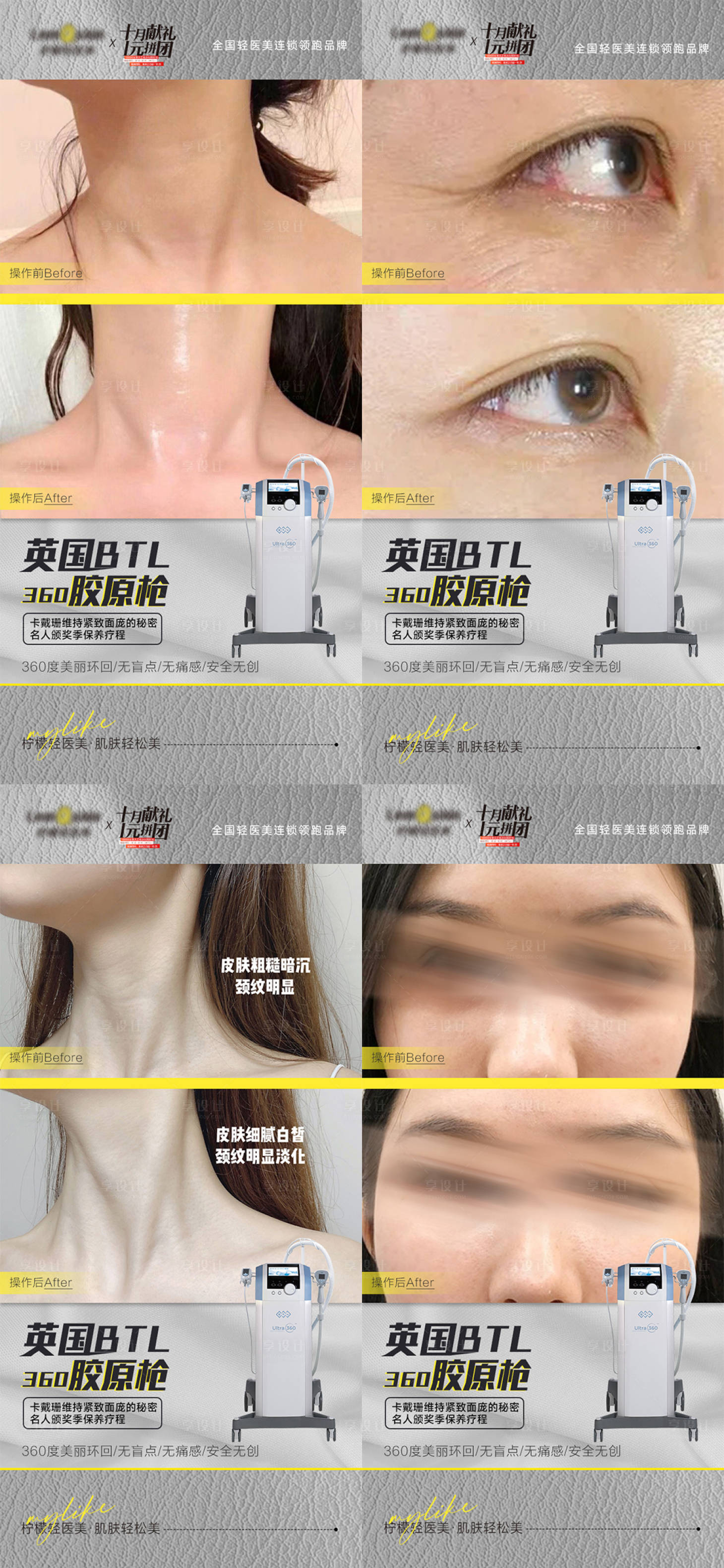 源文件下载【享设计】搜索编号：67660020689939011【医美仪器抗衰案例对比系列海报】
