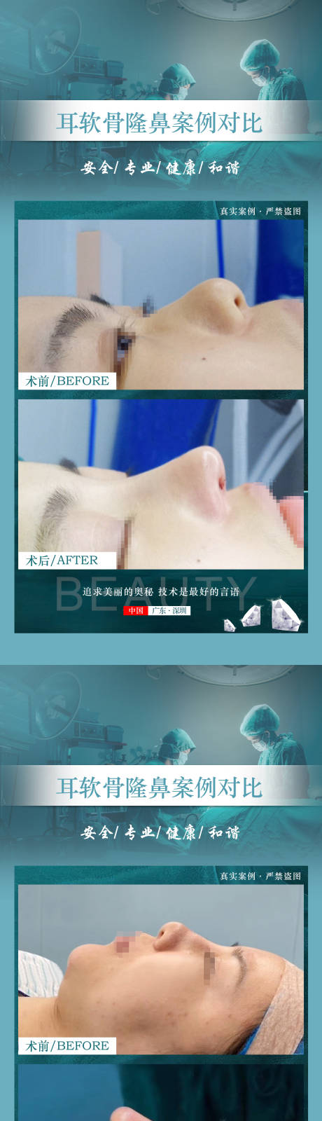 源文件下载【医美案例隆鼻】编号：90750020542011713