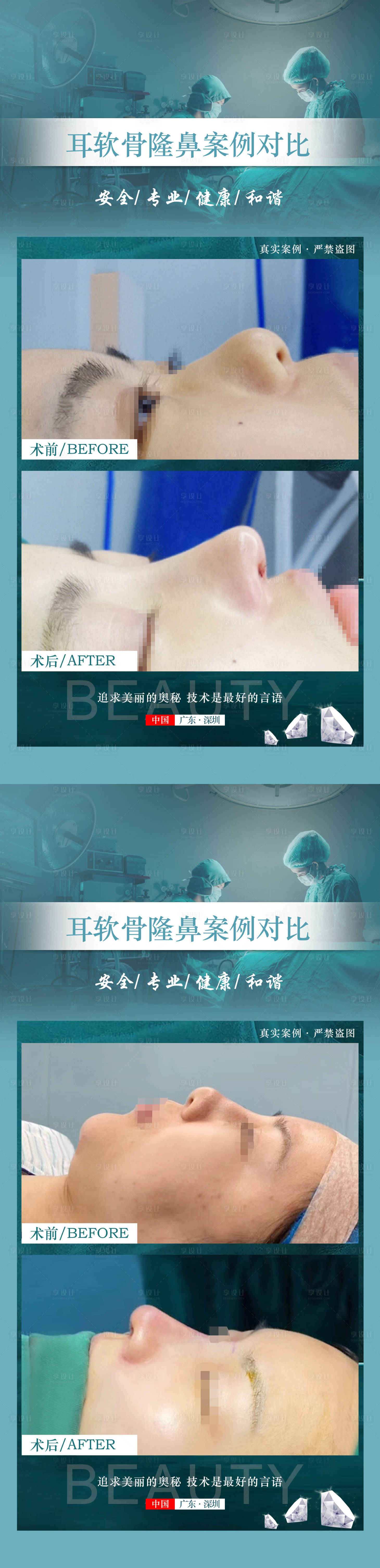 源文件下載【享設(shè)計(jì)】搜索編號(hào)：90750020542011713【醫(yī)美案例隆鼻】
