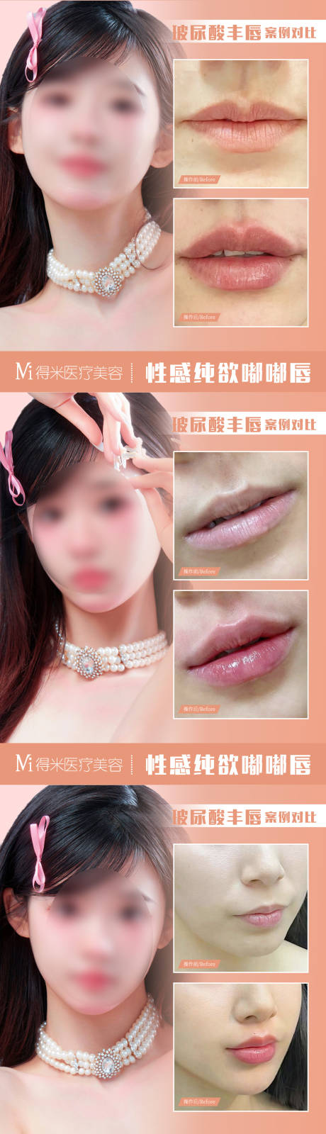 源文件下载【医美整形唇部案例对比】编号：10550020557286989