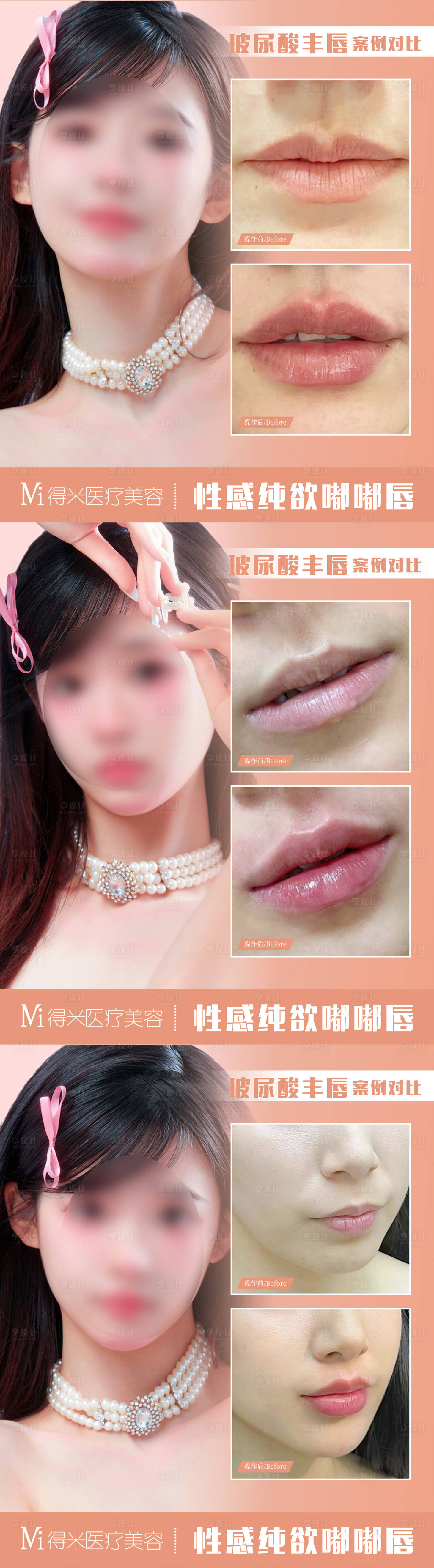源文件下載【享設計】搜索編號：10550020557286989【醫美整形唇部案例對比】